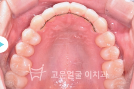 치료후기 이미지